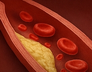 고지혈증에 좋은 음식