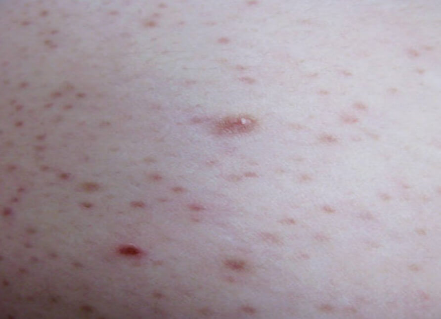 모공각화증 피부 증상