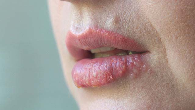 입술헤르페스(구순포진)란?