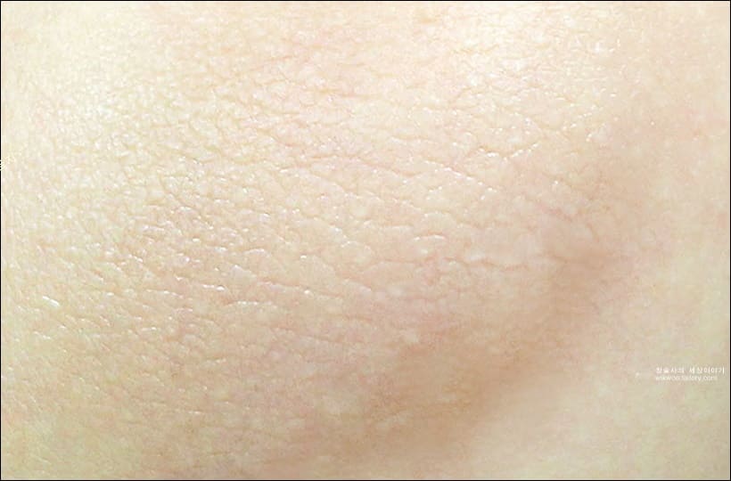 팔꿈치 착색 제거 후