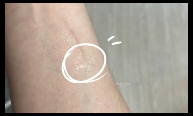 아드반탄 연고 가격