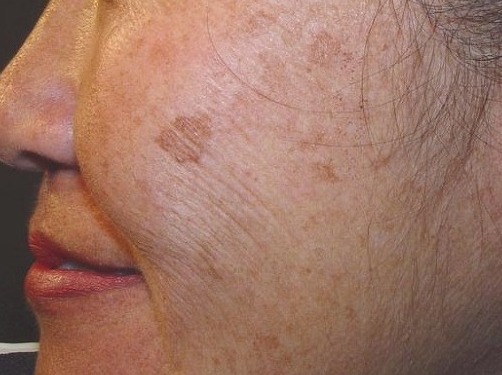 얼굴 검버섯 없애는 방법