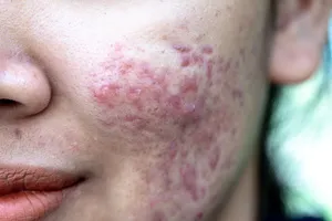 흉터제거-수술-비용