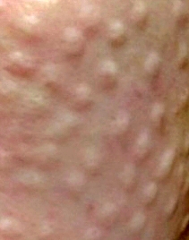 리쥬란힐러-엠보