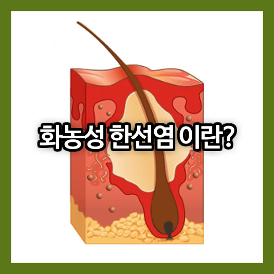 화농성 한선염 이란?
