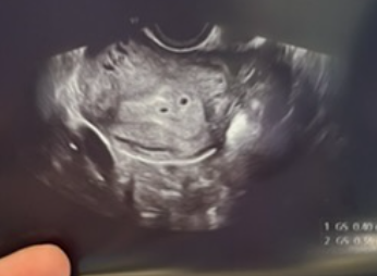 쌍둥이 임신 태몽 후기: 꿈에서 작은 참새 두 마리가 들어왔어요!