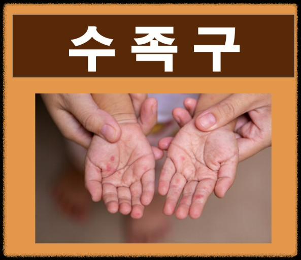 꼭 알아야 할 수족구병: 원인, 예방, 증상, 치료 방법