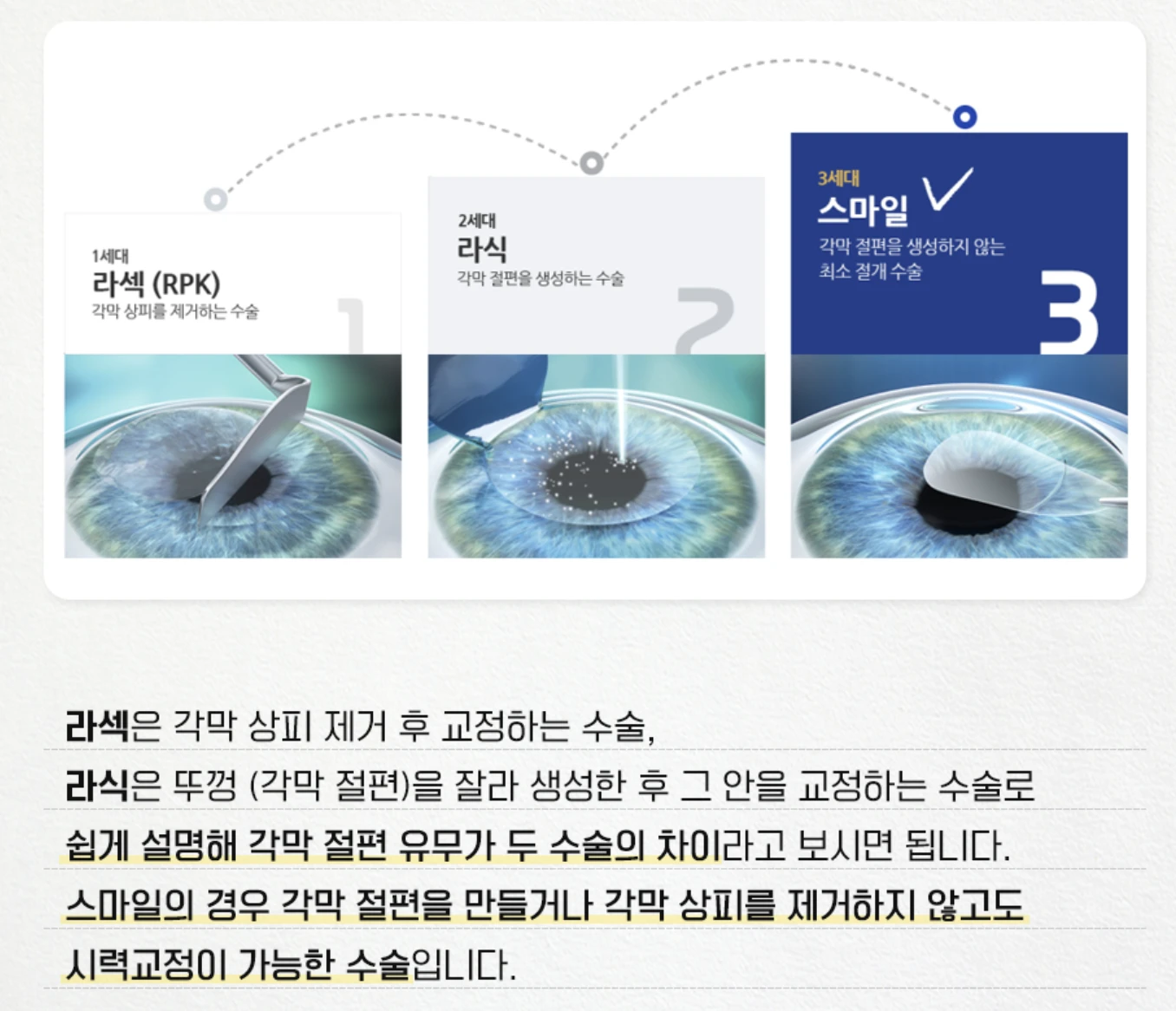 시력교정술 개념