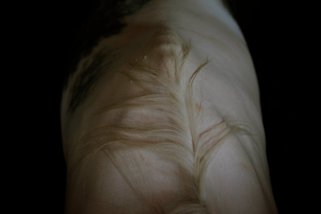 Sprain