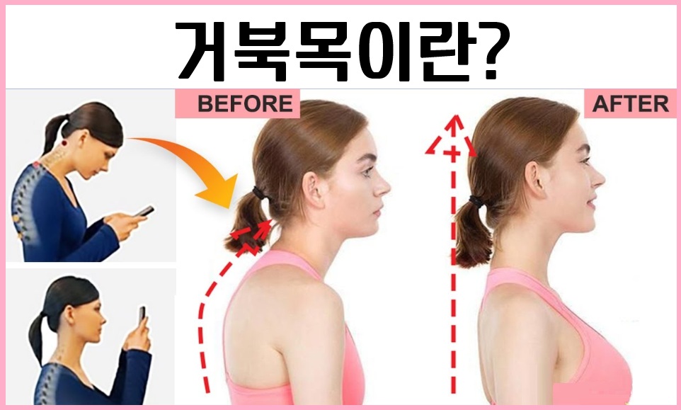거북목 교정 완벽 가이드: 효과적인 운동법과 팁