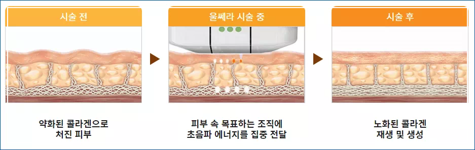 울쎄라 시술전후