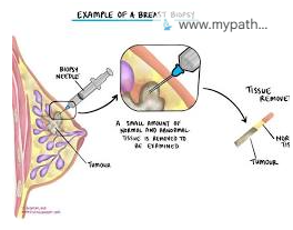 침윤성·비침윤성 유방암, 삼중 음성·HER2 양성