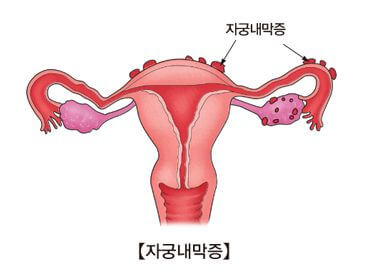 자궁내막증