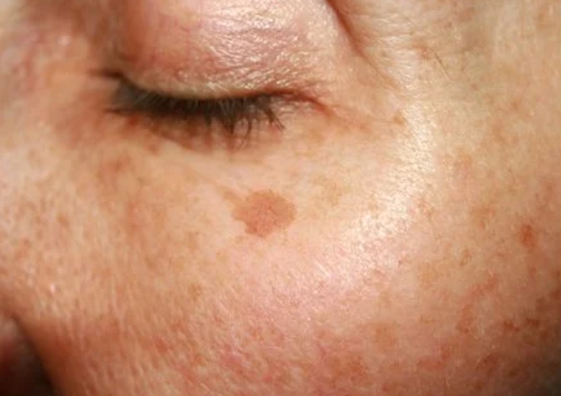 기미 잡티 제거