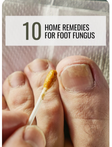 무좀-치료제-추천