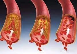 혈관 청소 사진 1