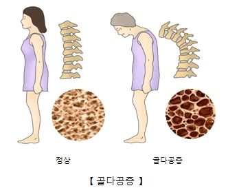 골다공증 주사 부작용