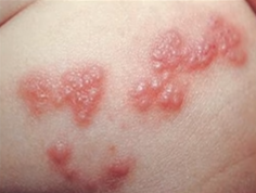 대상포진 초기증상