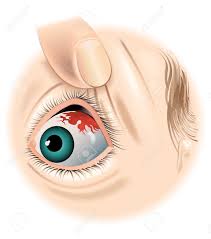 눈 실핏줄이 터지는 이유