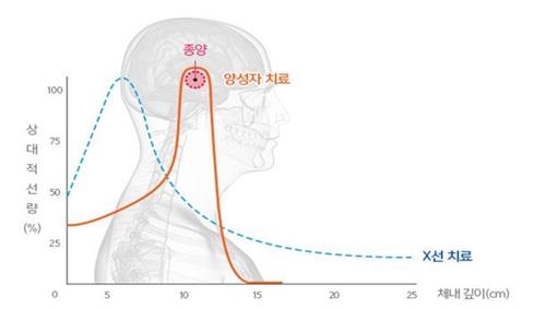 암 방사능 치료