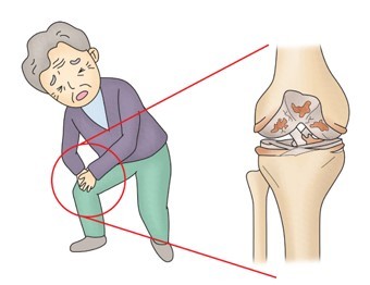 시니어들의 무릎 통증: 원인과 관리 방법