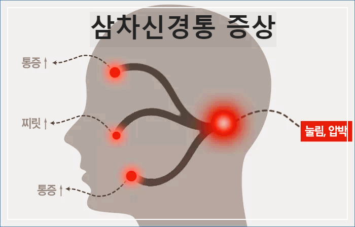 삼차신경통 증상