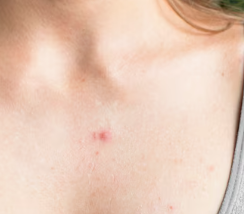 피부암 초기증상 14