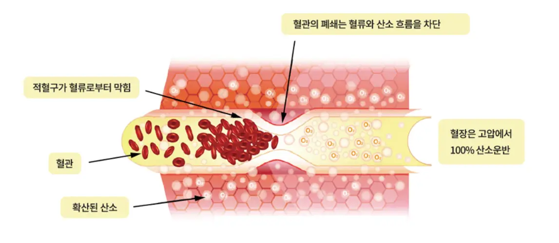 고압산소케어-효과