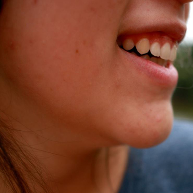 화농성 좁쌀 여드름