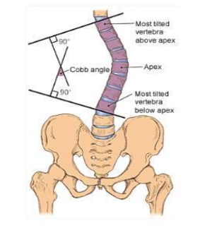 척추측만증검사: cobb's-angle