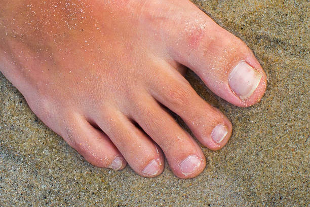 발톱무좀으로 힘든가요? 제대로 치료하는 부산 피부과 찾는법!