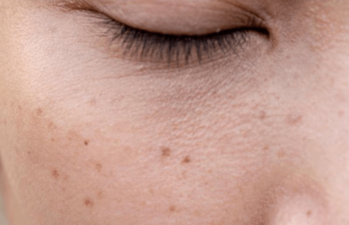 기미 색소침착 예방