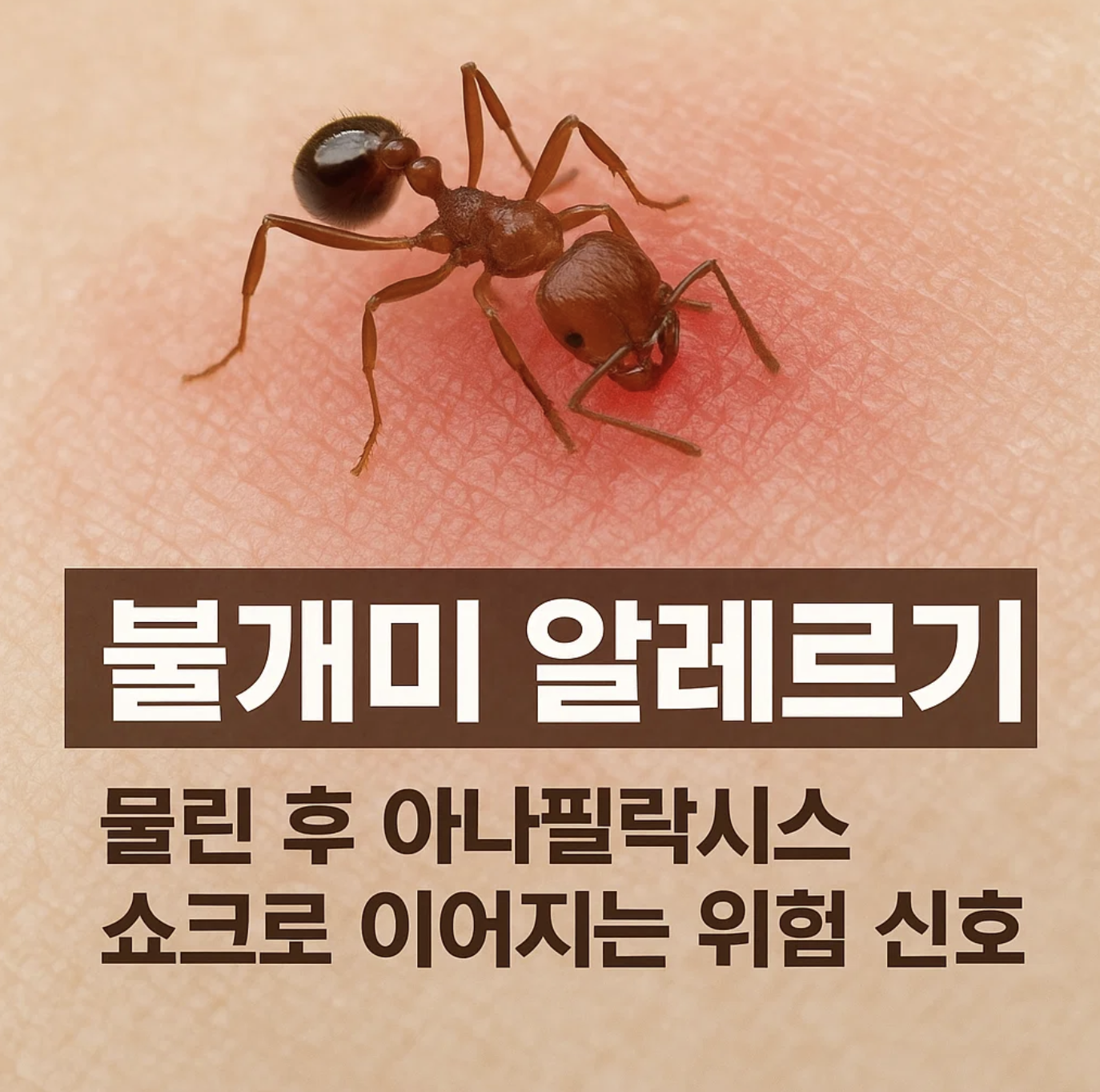 불개미 알레르기, 물린 후 아나필락시스 쇼크로 이어지는 위험 신호