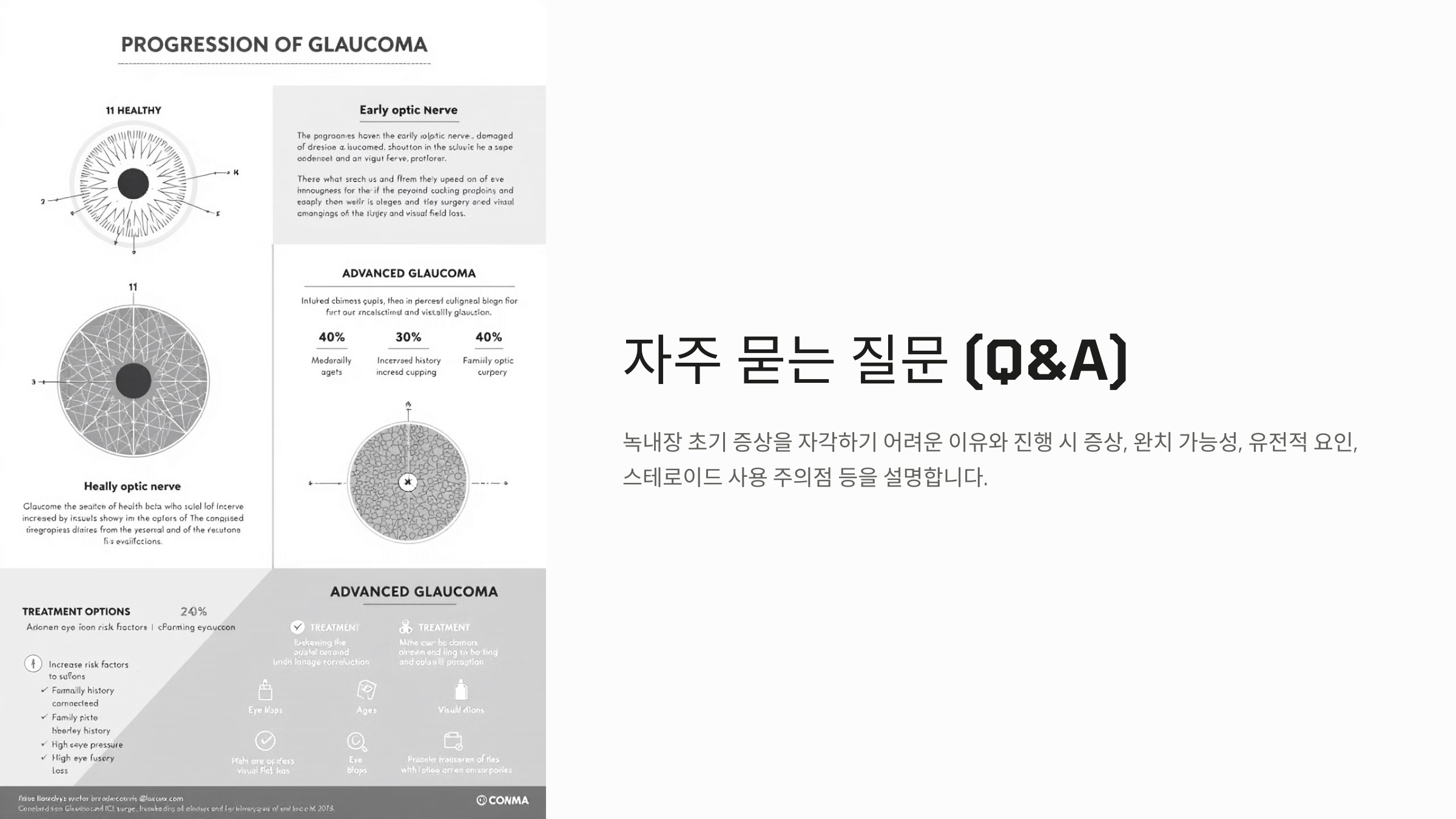 녹내장과 관련된 사진입니다.