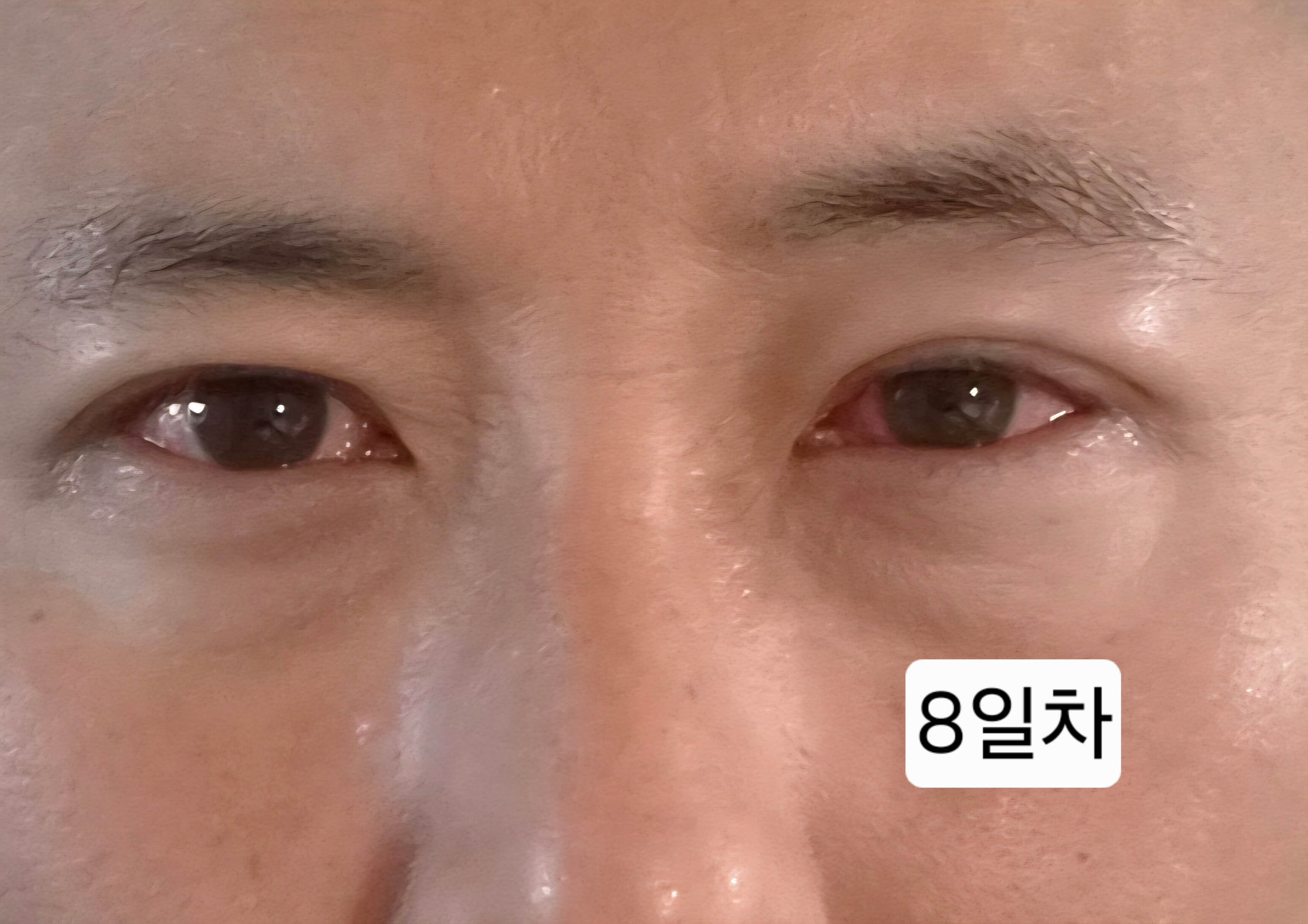 유행성각결막염 눈병 초기증상부터 12일차 치료 기록(진행 중)