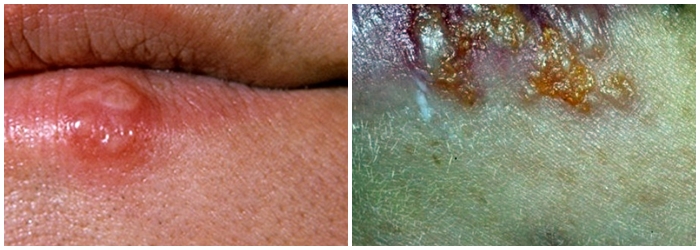 스트레스로 인한 발진