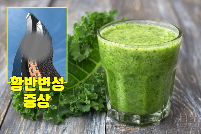 눈에 좋은 비타민 많은 음식 루테인 지아잔틴 케일 시금치