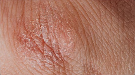 각질이 생긴 피부