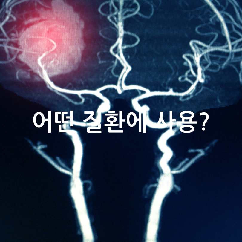 뇌혈관 조영술