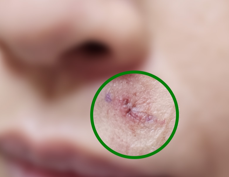 얼굴 피지낭종 제거 후기