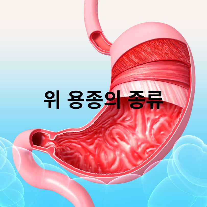 위 용종 암일확률? 걱정되는 분들을 위한 정확한 정보