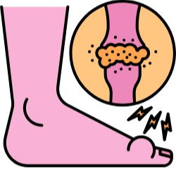 맥주 - 통풍 유발 시킴