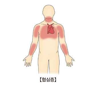 왼쪽 옆구리 통증 찌릿 찌르는 불편감 췌장 위암 암 가스