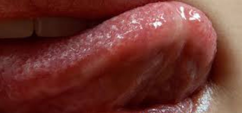 혓바늘 원인 6가지 및 혓바늘 없애는 방법과 치료제 추천