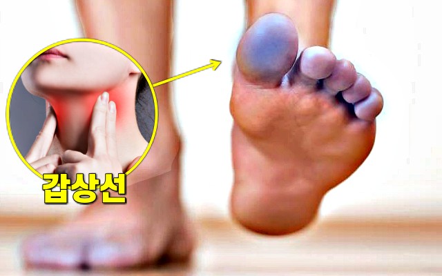 발이 시린 증상, 갑상선 기능 저하증