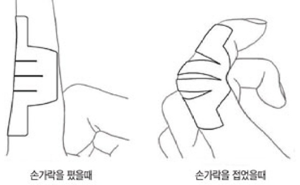 손가락 관절염 치료법 2