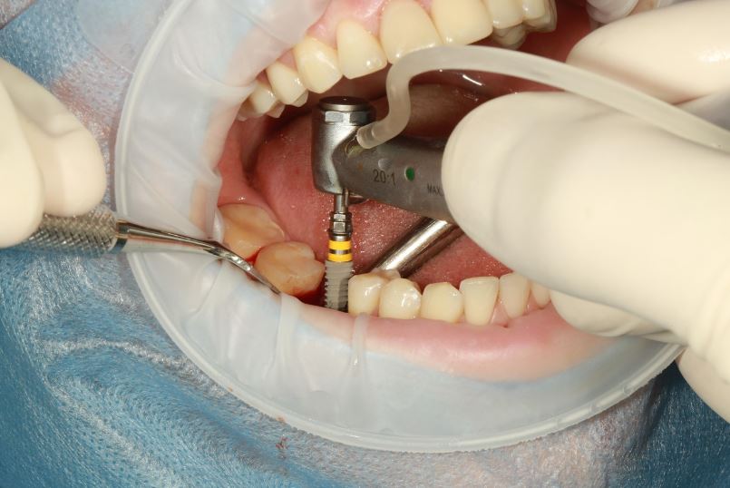 65세이상 노인 의료 혜택: 틀니 임플란트 신청방법