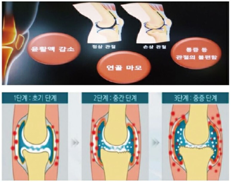 관절염 발생과 진행