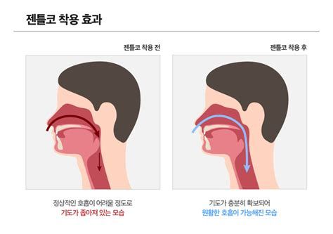 코골이 고치는 법