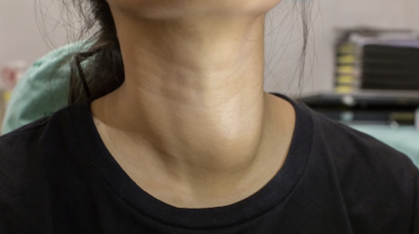 갑상선암 증상